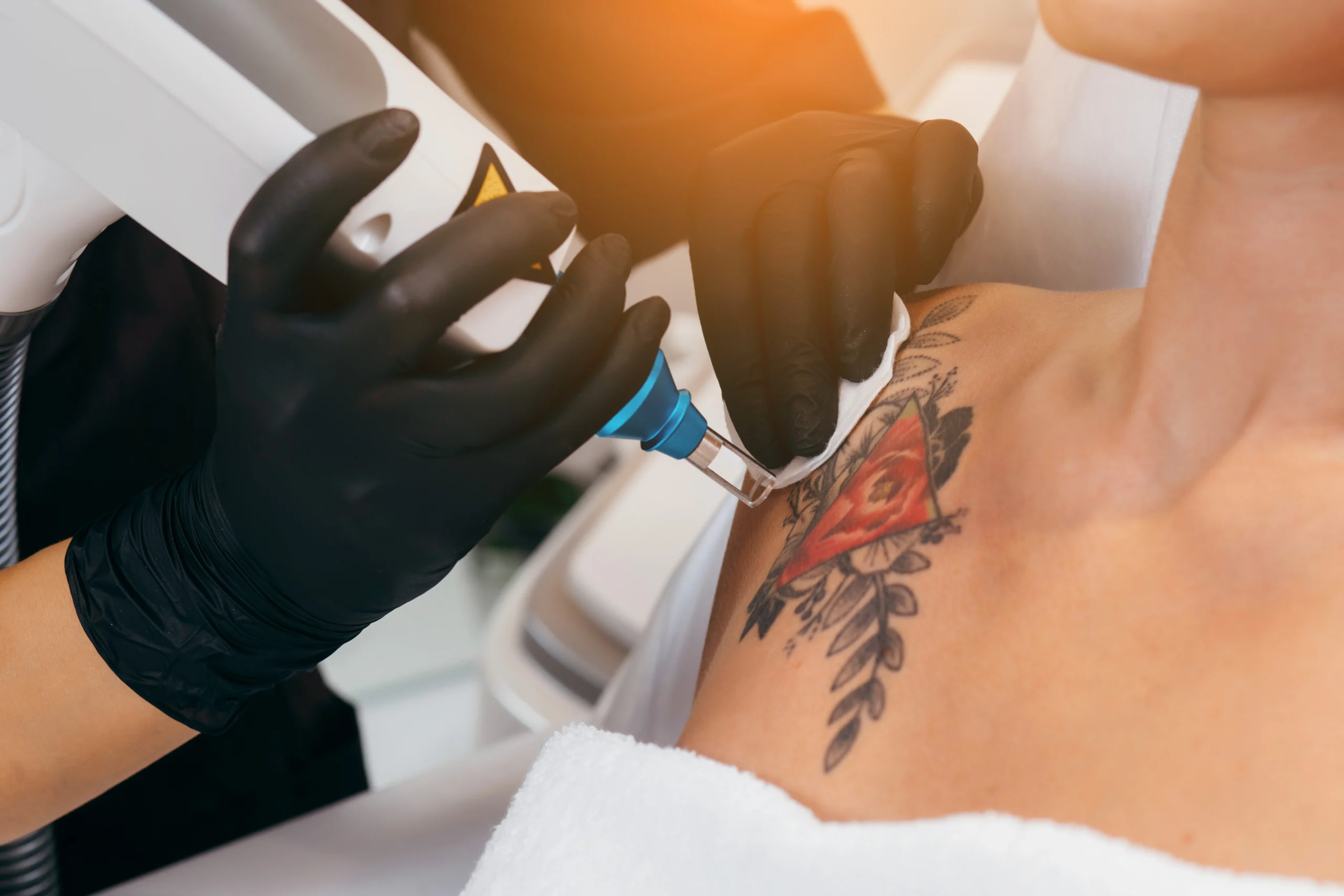 Laser Tattoo Removal