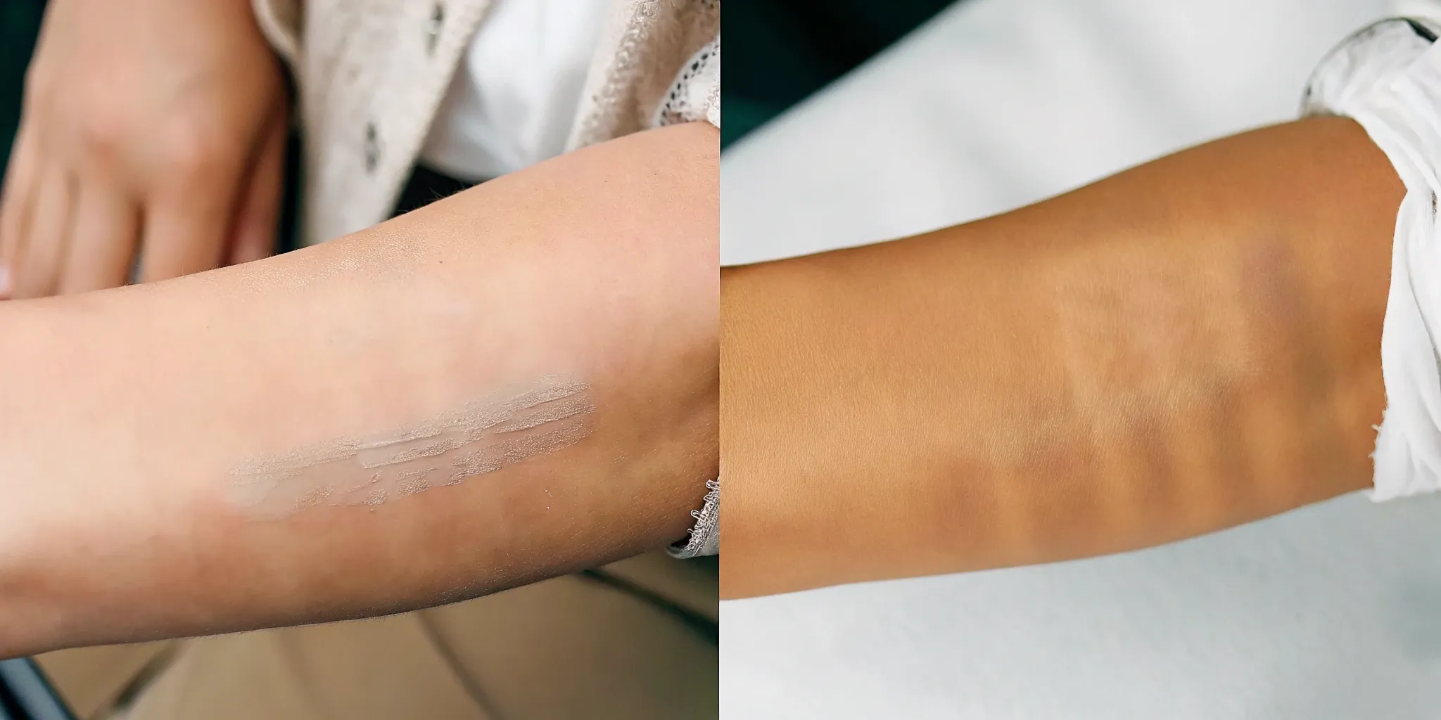 Tattoo removal before and after, showing forearm fading.
