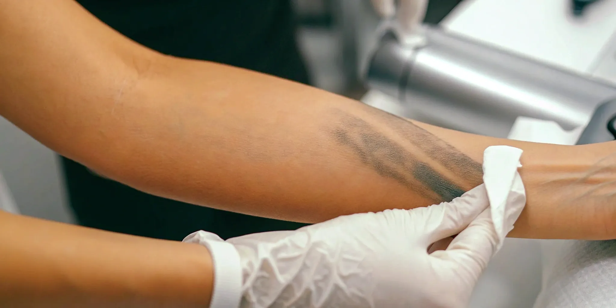 A technician uses a laser for black ink tattoo removal on a forearm.