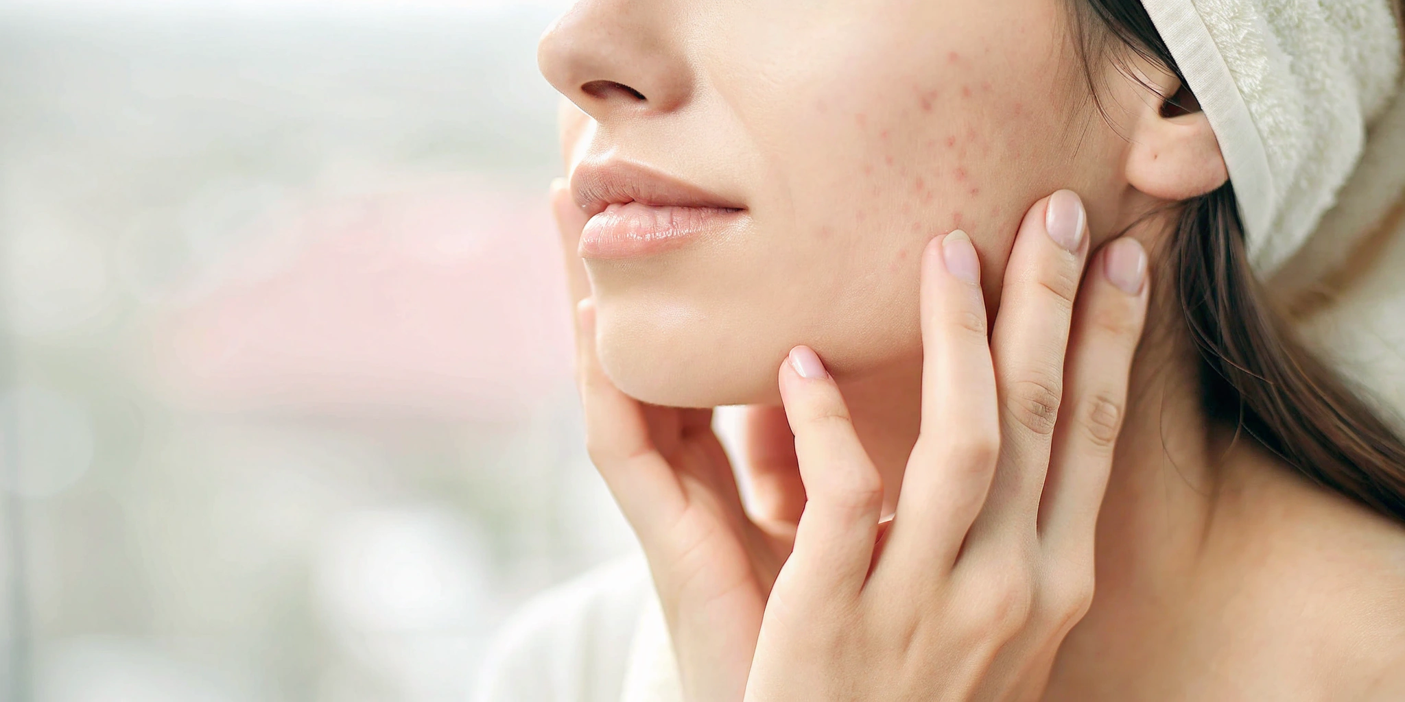 Woman's cheek with acne scars before receiving a VI Peel.