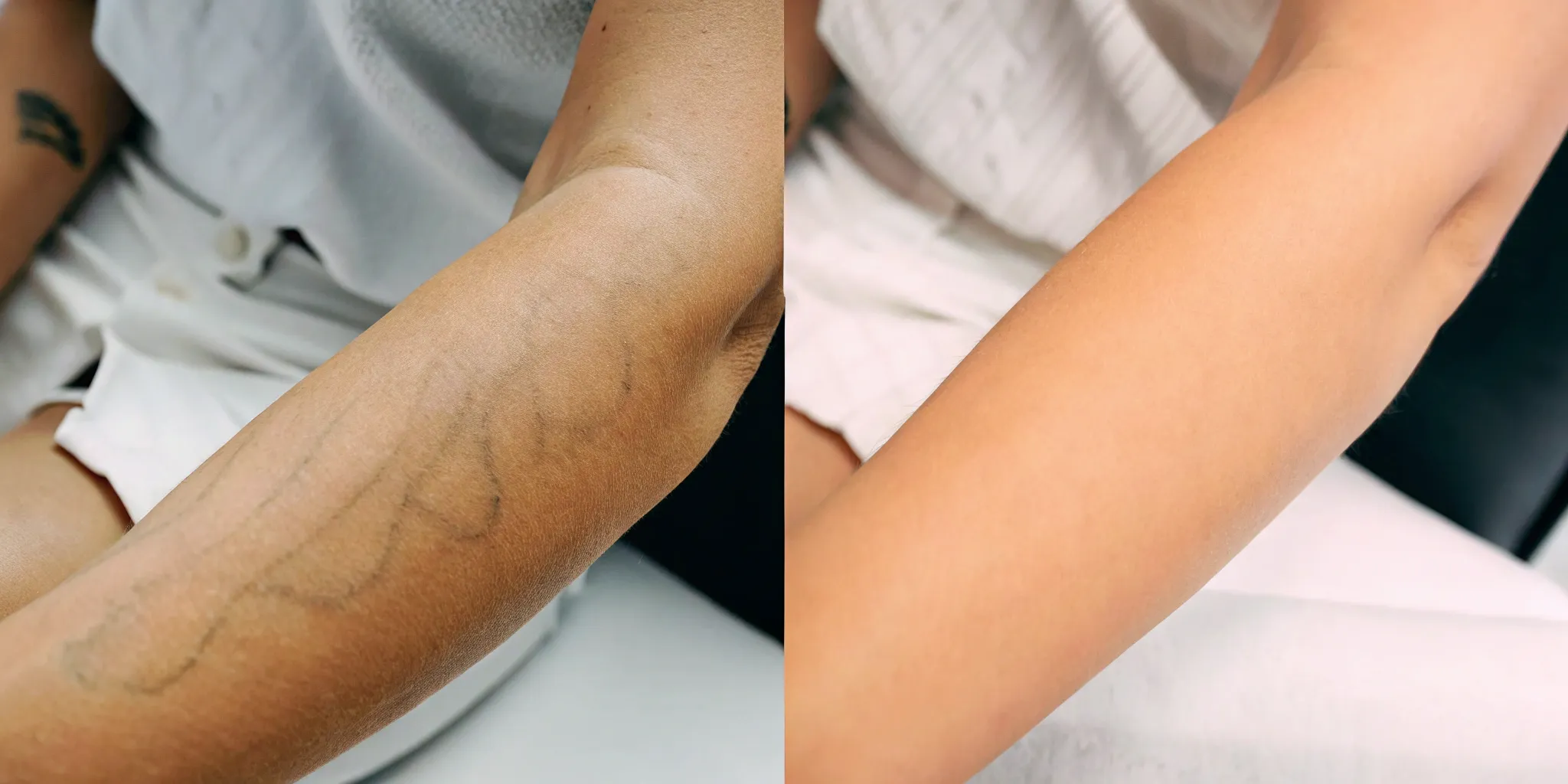 Tattoo removal before & after at Shipers Laser Tattoo Removal Dallas.