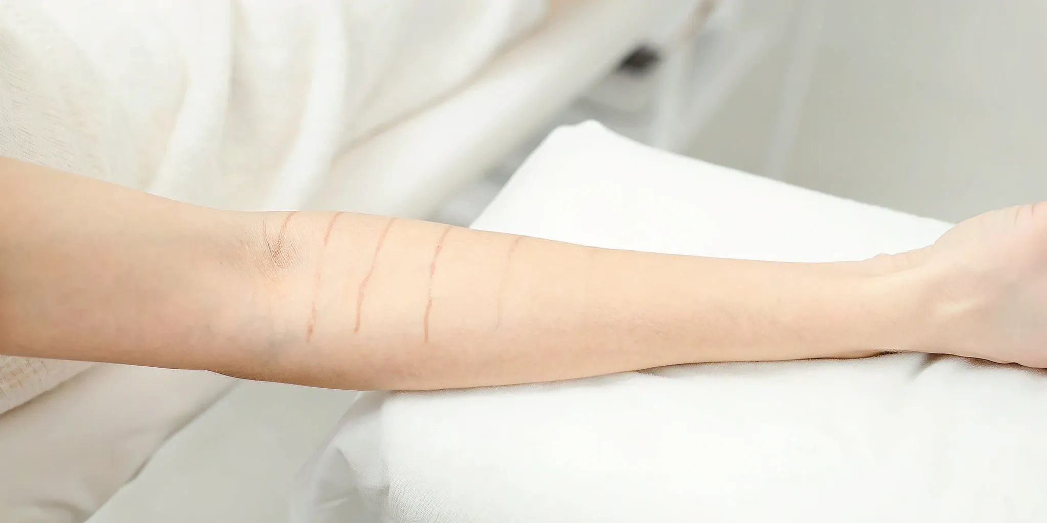 Faded forearm tattoo showing the progress after many tattoo removal sessions.