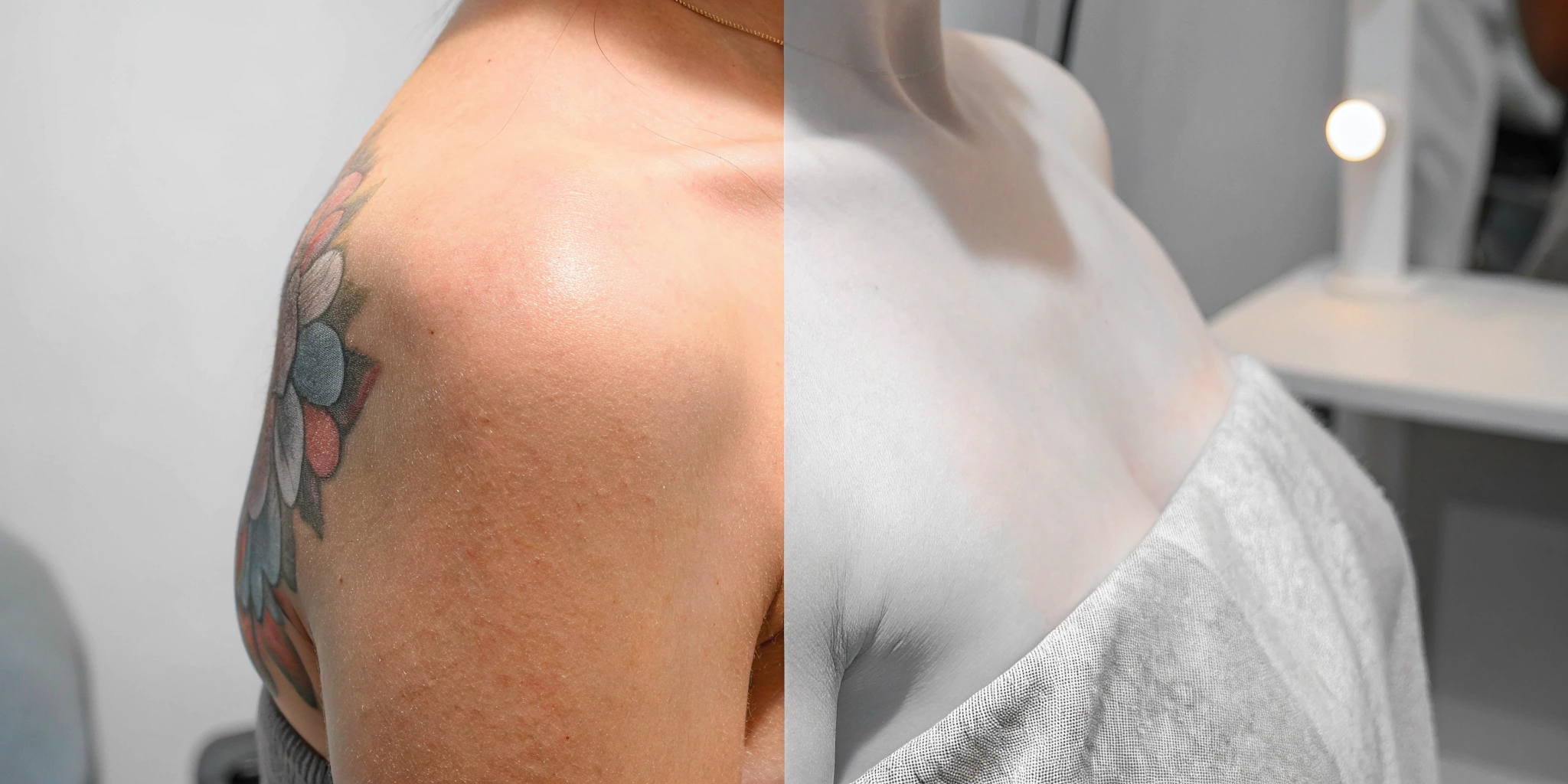 A shoulder tattoo before and after PicoSure removal in Dallas, revealing clear skin.