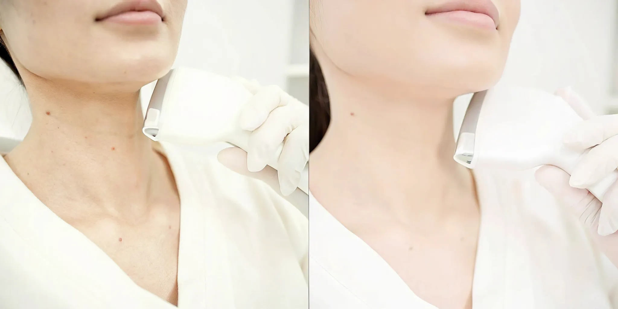 Laser hair removal on the chin and neck helps reduce razor bumps.