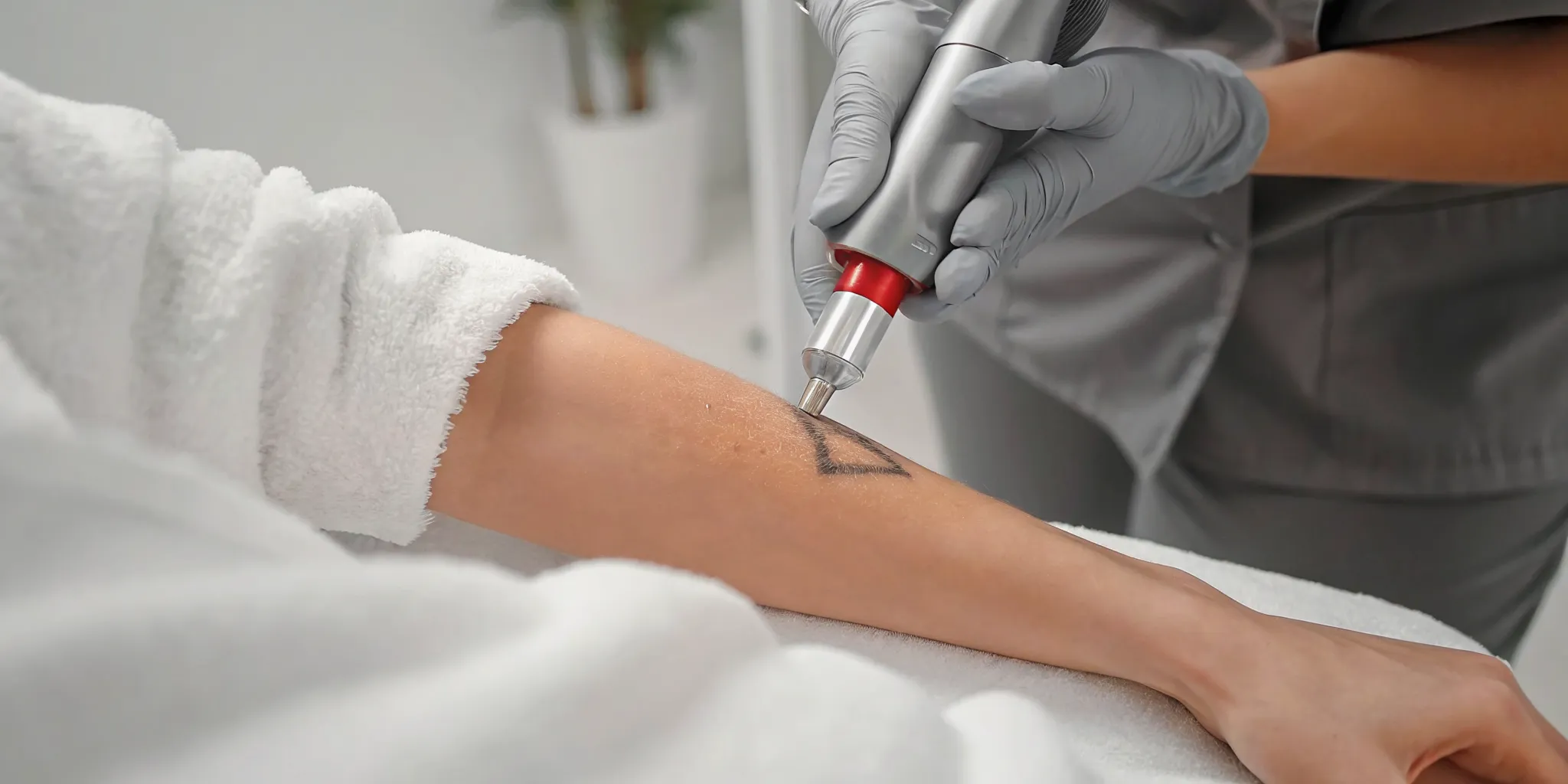Laser tattoo removal session on a forearm, a procedure that can be painful.