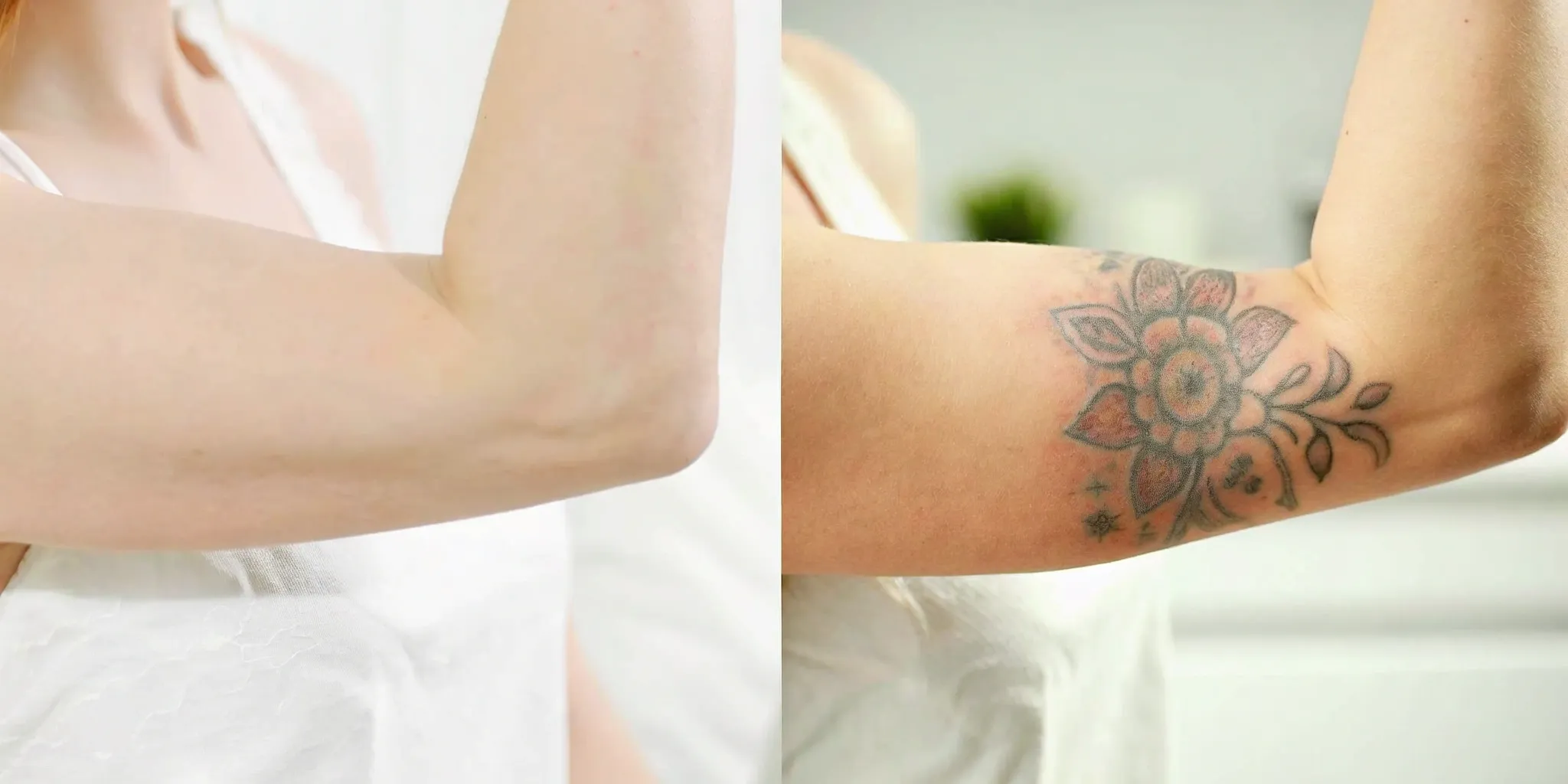 Tattoo removal before and after: faded floral tattoo.